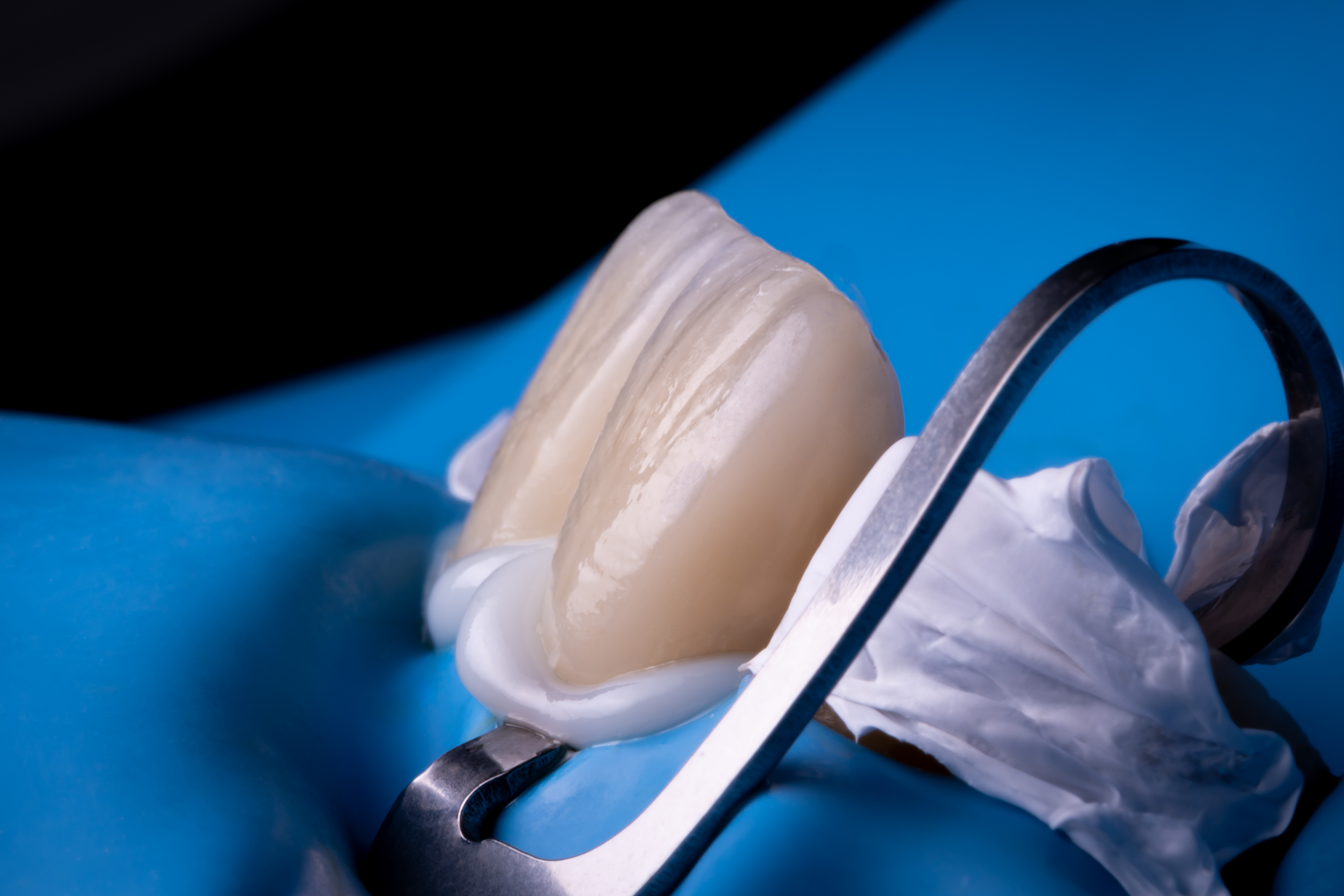 Porcelain Veneers