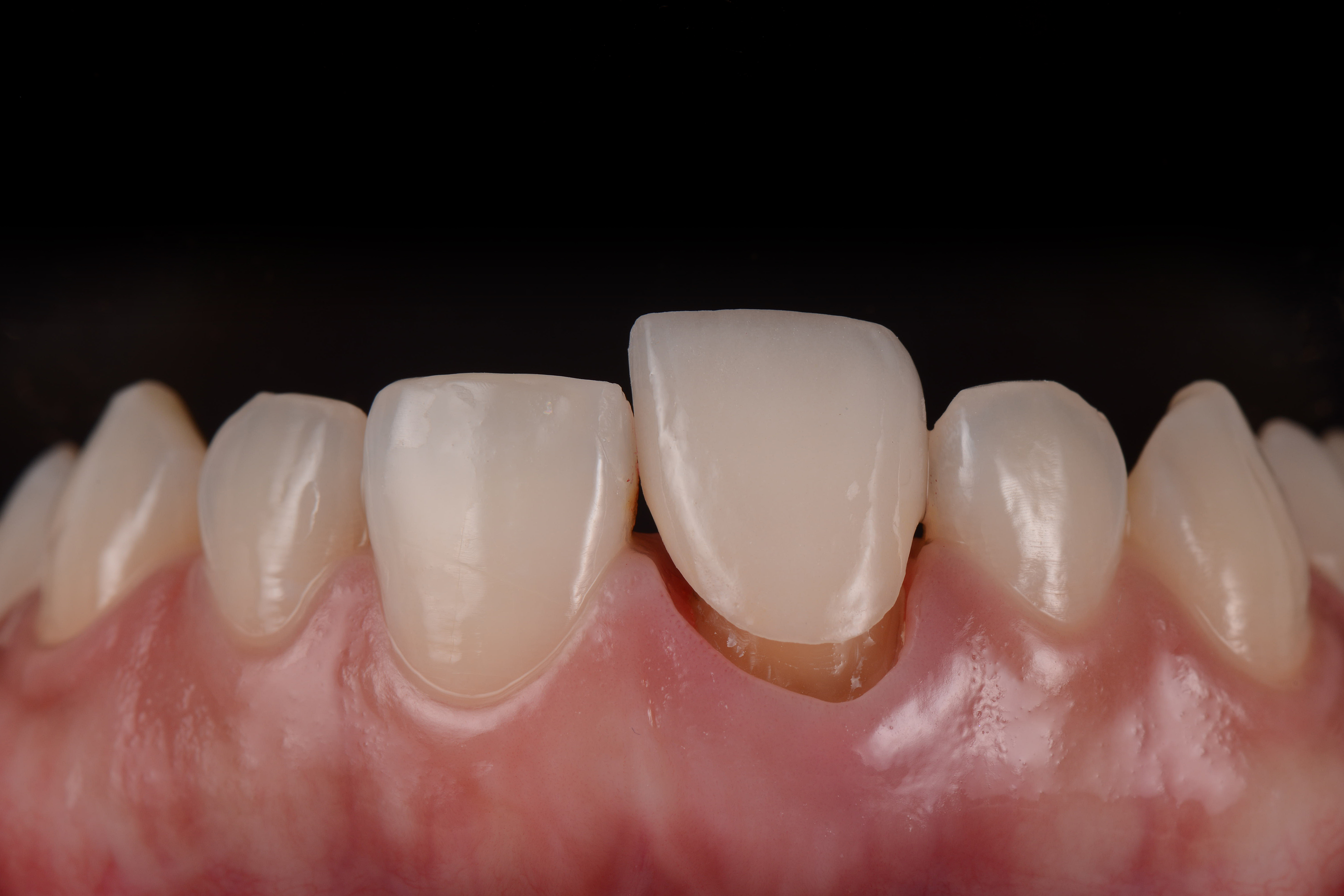 Provisional Crowns