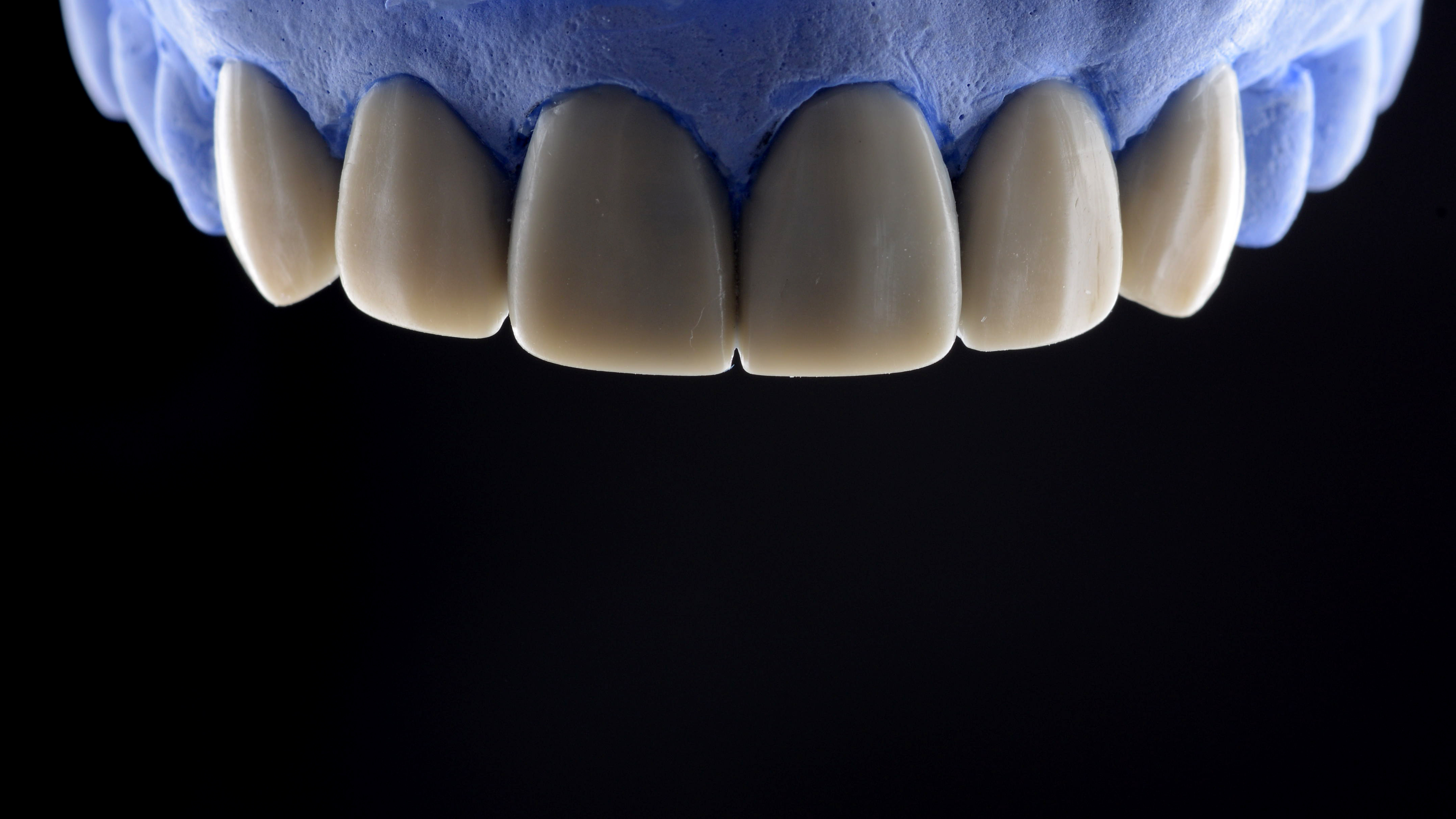 Diagnostic wax-up process