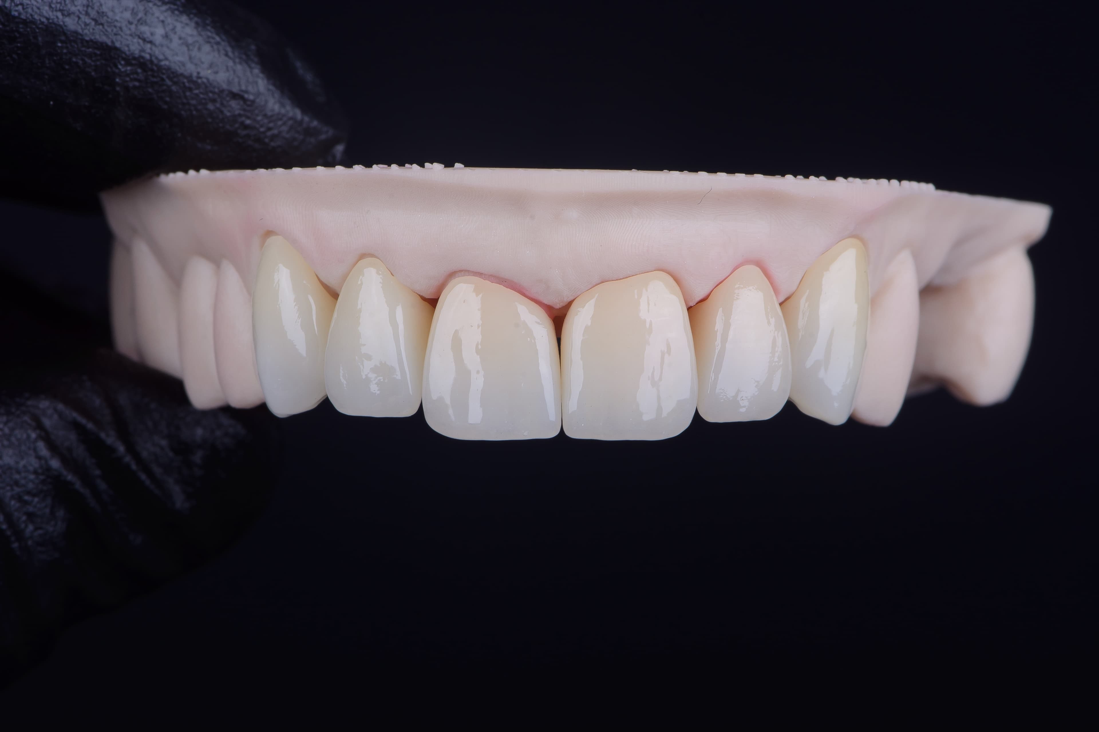 All-Ceramic Restorations